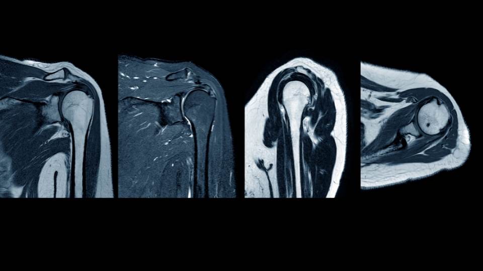 mri of the shoulder dublin physio