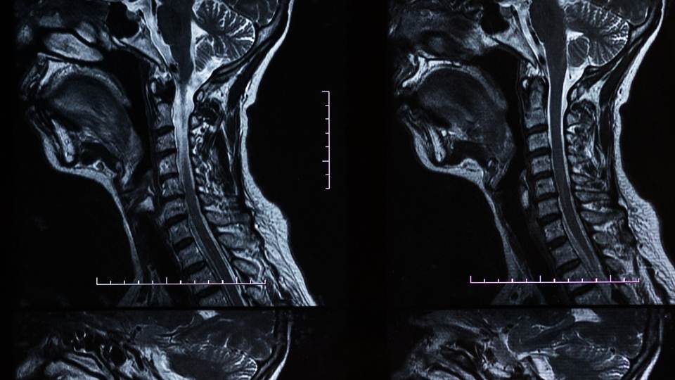 Brachial Plexus Injury Treatment & Relief
